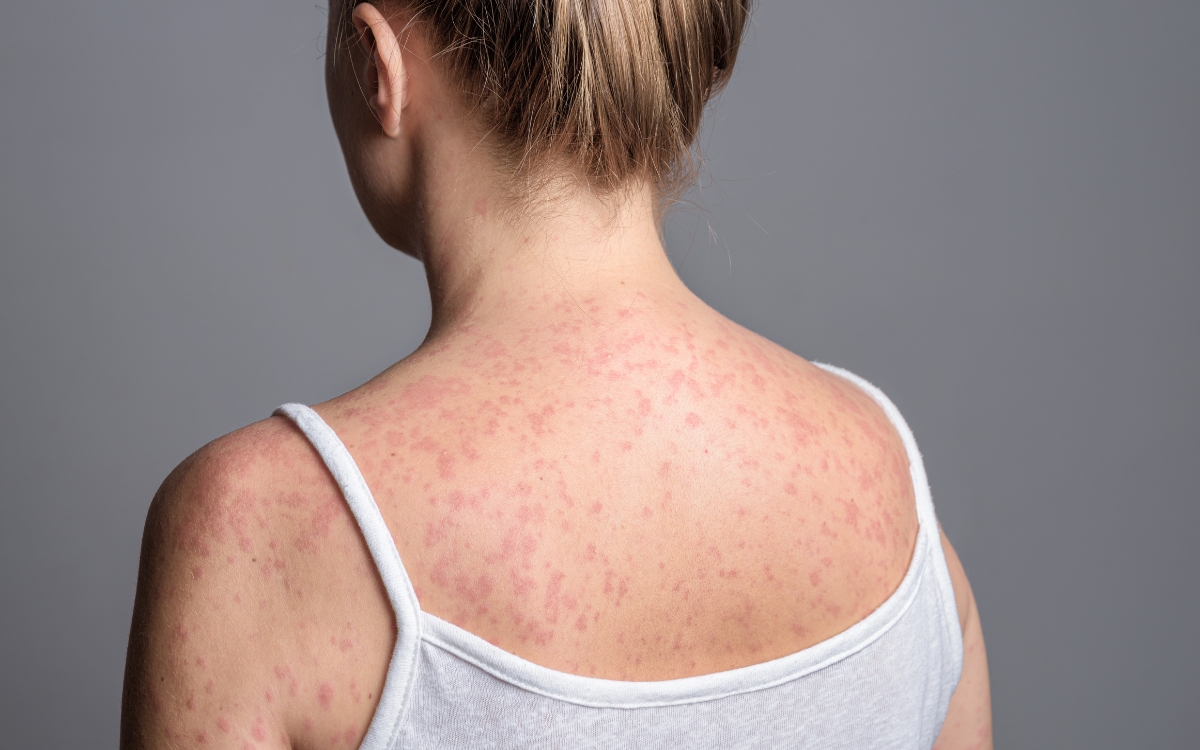 Sarampo é contagioso? Quem corre mais risco? Tire as principais dúvidas 1 Sarampo é contagioso