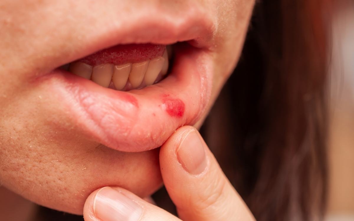 Afta na boca: estresse, falta de vitamina ou algum problema de saúde? 1 O que causa afta na boca