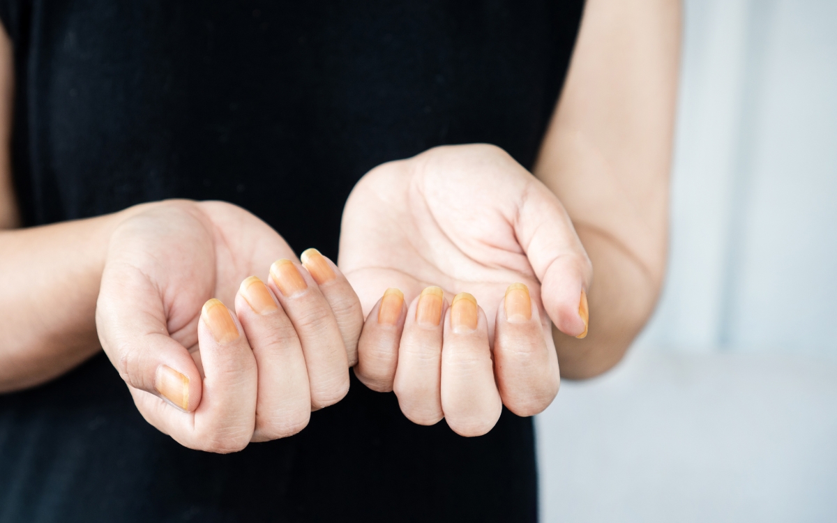 Unhas amareladas