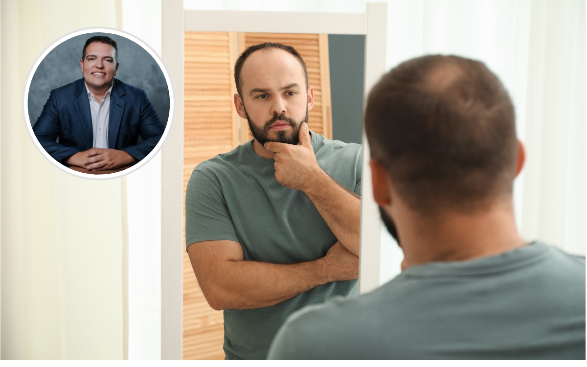 A calvície não começa quando o cabelo cai. Ela começa quando você muda seus hábitos 1 Calvície