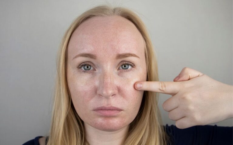 Tem pele oleosa e foge do hidratante? Veja o que os dermatologistas orientam 2 Hidratante para pele oleosa