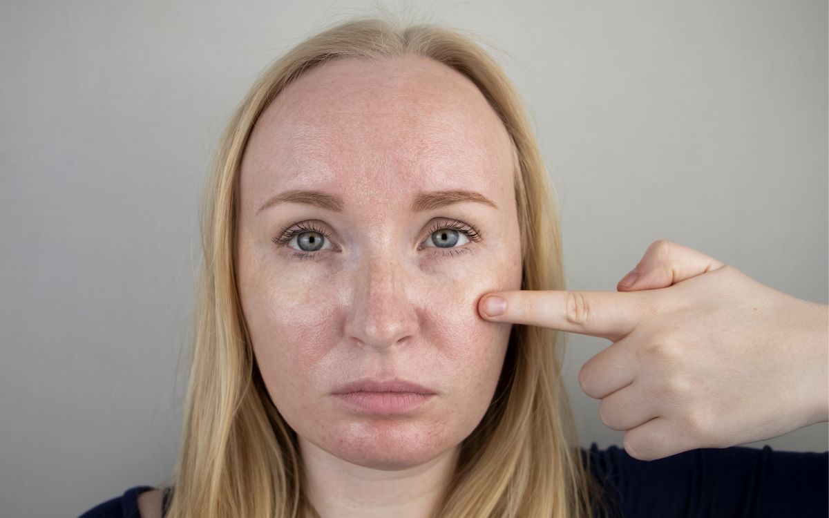Tem pele oleosa e foge do hidratante? Veja o que os dermatologistas orientam 1 Hidratante para pele oleosa