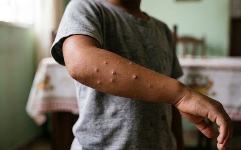 Molusco contagioso na pele: como pega e quando é preciso se preocupar 2 Molusco na pele