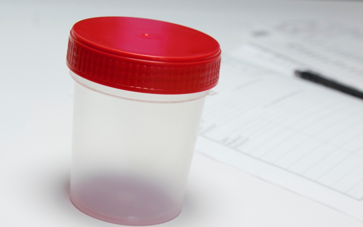Infecção urinária: o exame que pode revelar o que está por trás do problema 1 Para que serve o exame de urocultura