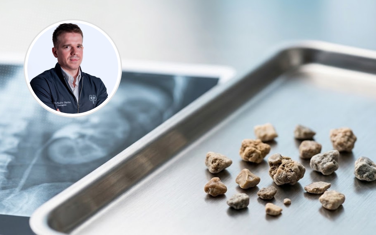 Pedra no rim de 5 mm sai sozinha? Urologista explica quando esperar e quando operar 1 Pedra no rim de 5 mm sai sozinha