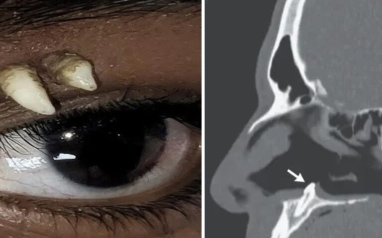 Dente ectópico
