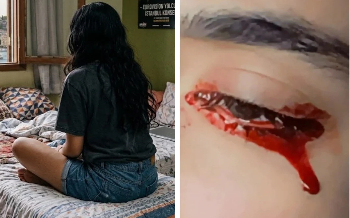 Adolescente chorava sangue durante a menstruação e médicos suspeitaram de endometriose 2 Lagrimas de sangue 2