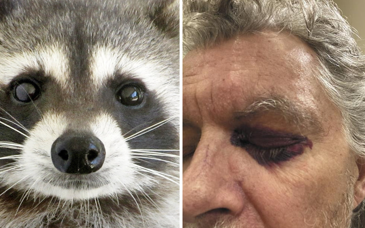 Atenção aos olhos de guaxinim: eles surgiram do nada em mulher de 60 anos e revelaram uma doença rara que pode comprometer o coração e os rins 3 Olhos de guaxinim