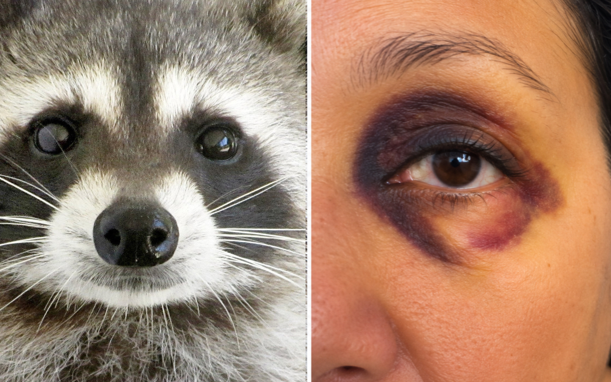 Atenção aos olhos de guaxinim: eles surgiram do nada em mulher de 60 anos e revelaram uma doença rara que pode comprometer o coração e os rins 2 Olhos de guaxinim