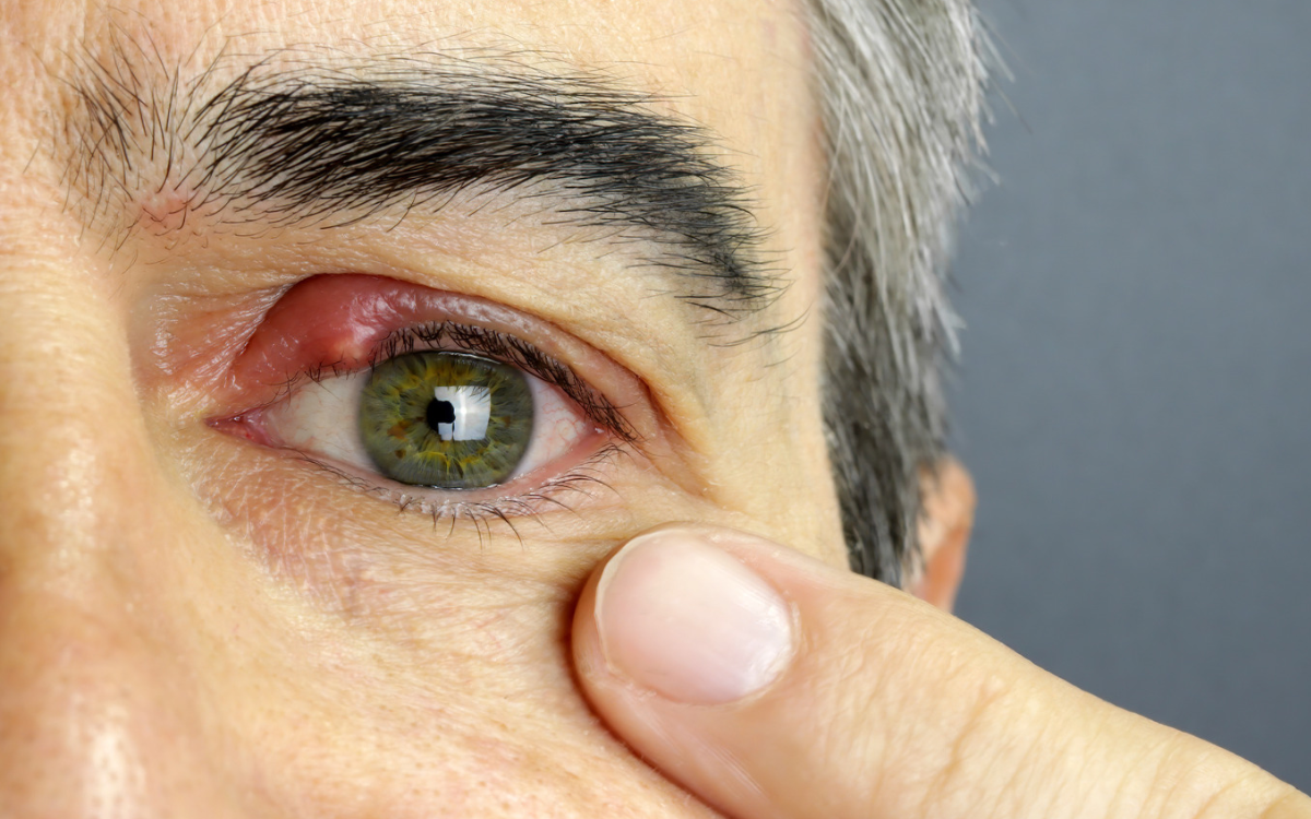 Terçol é contagioso