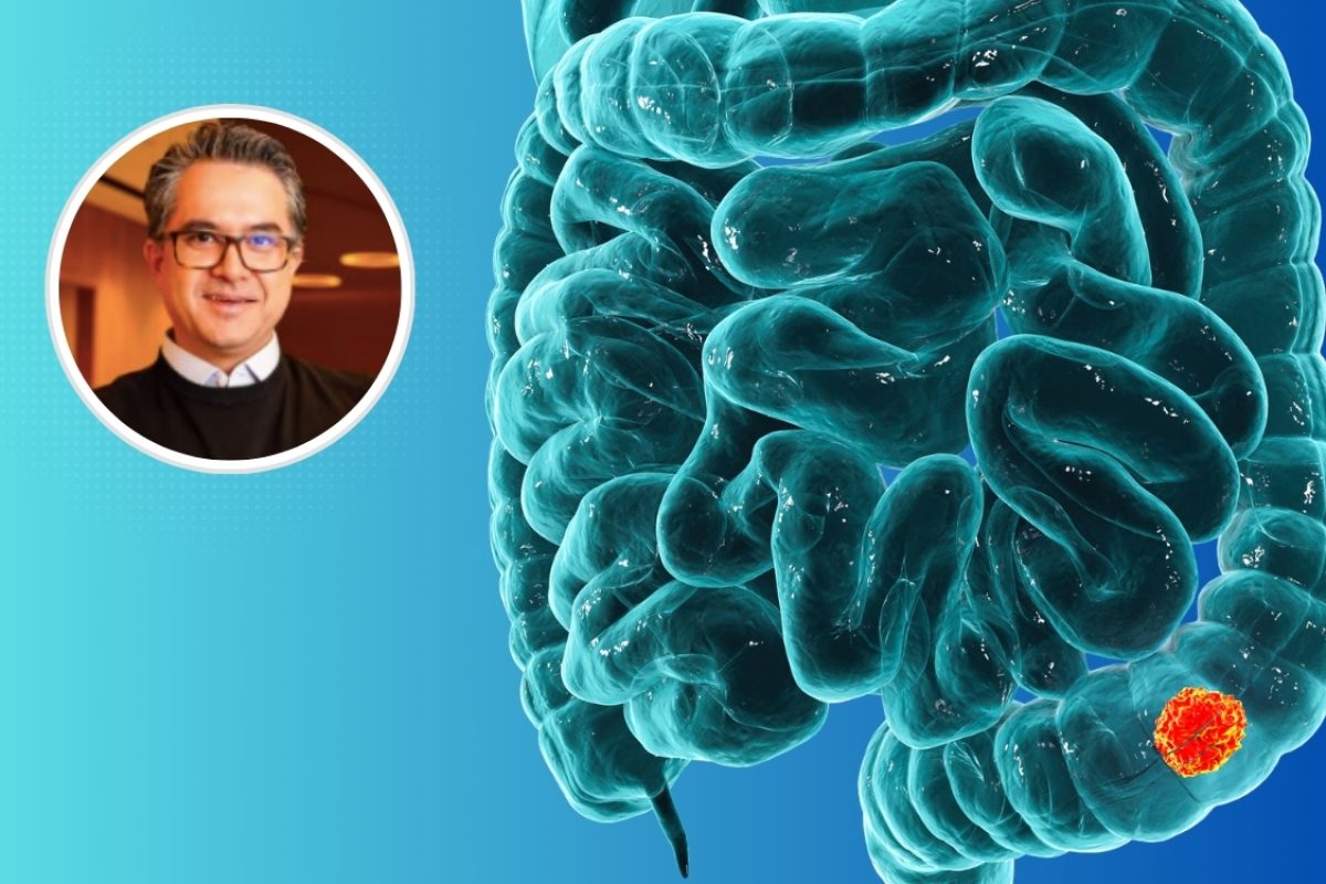 Câncer de intestino  / Canva