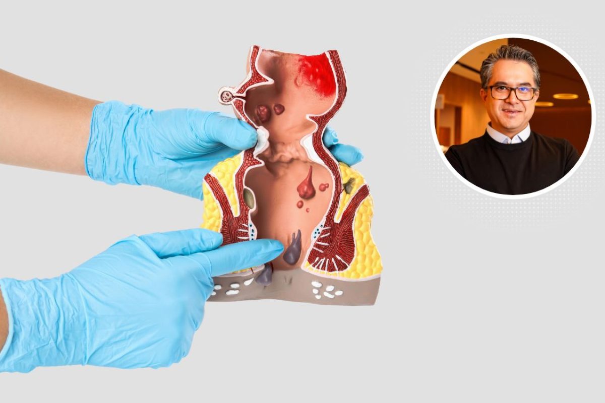 Cirurgia de hemorroidas sem cortes.