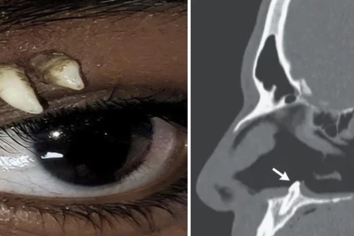 Dente ectópico
