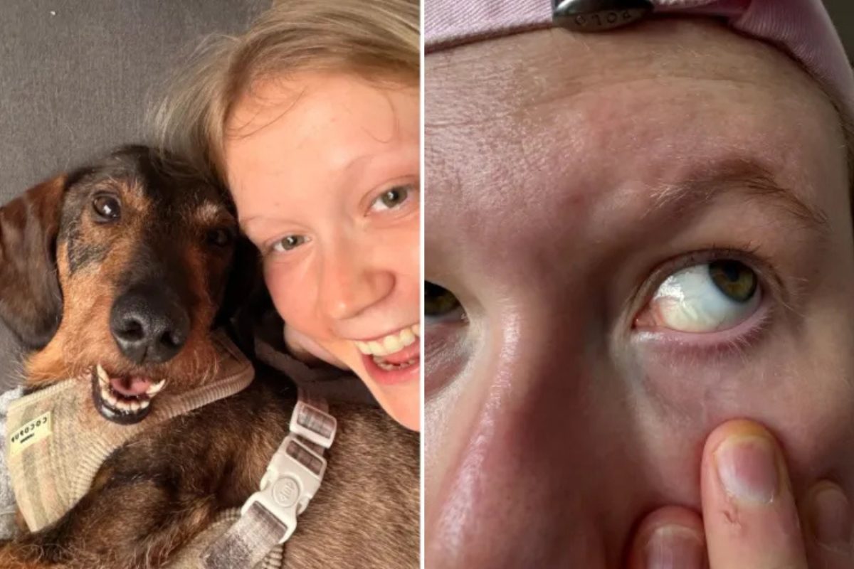 Alabama Jackson e o cão Goober. Após esfregar os olhos a jovem desenvolveu um cisto conjuntival  / Crédito: Alabama Jackson