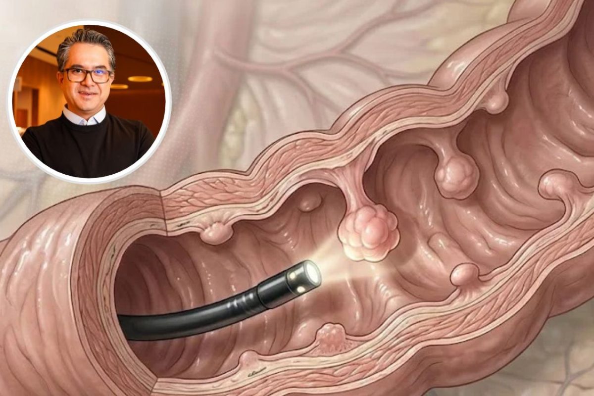 Pólipo intestinal.