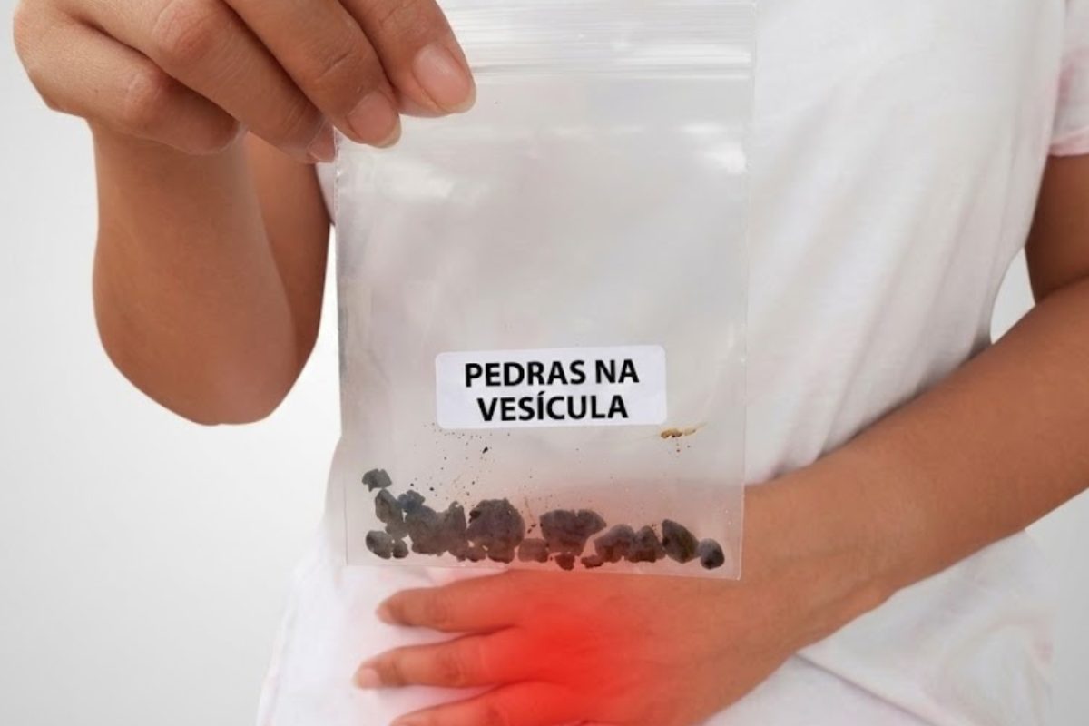 Quais os sintomas de pedra na vesícula