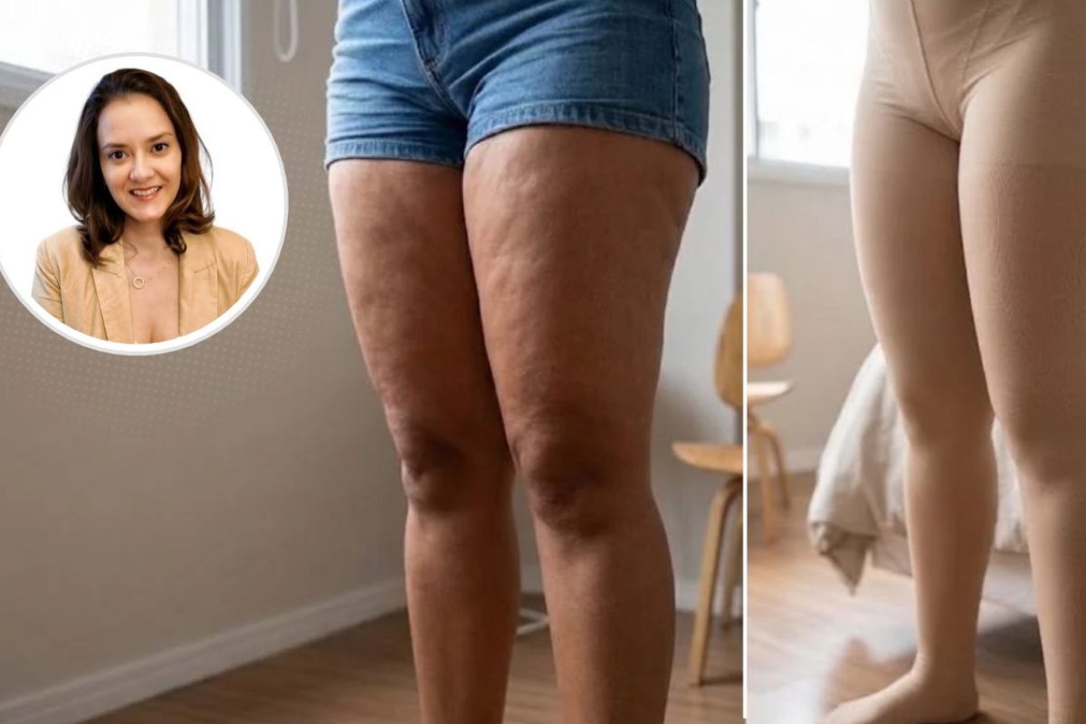 Recuperação após cirurgia de lipedema.