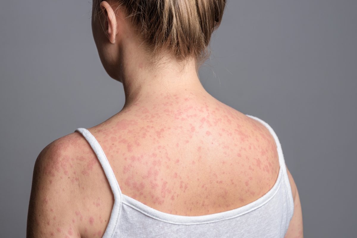 Sarampo é contagioso