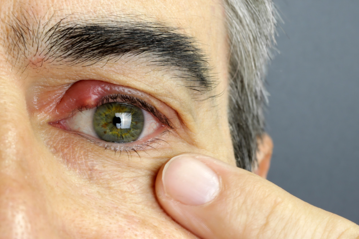 Terçol é contagioso
