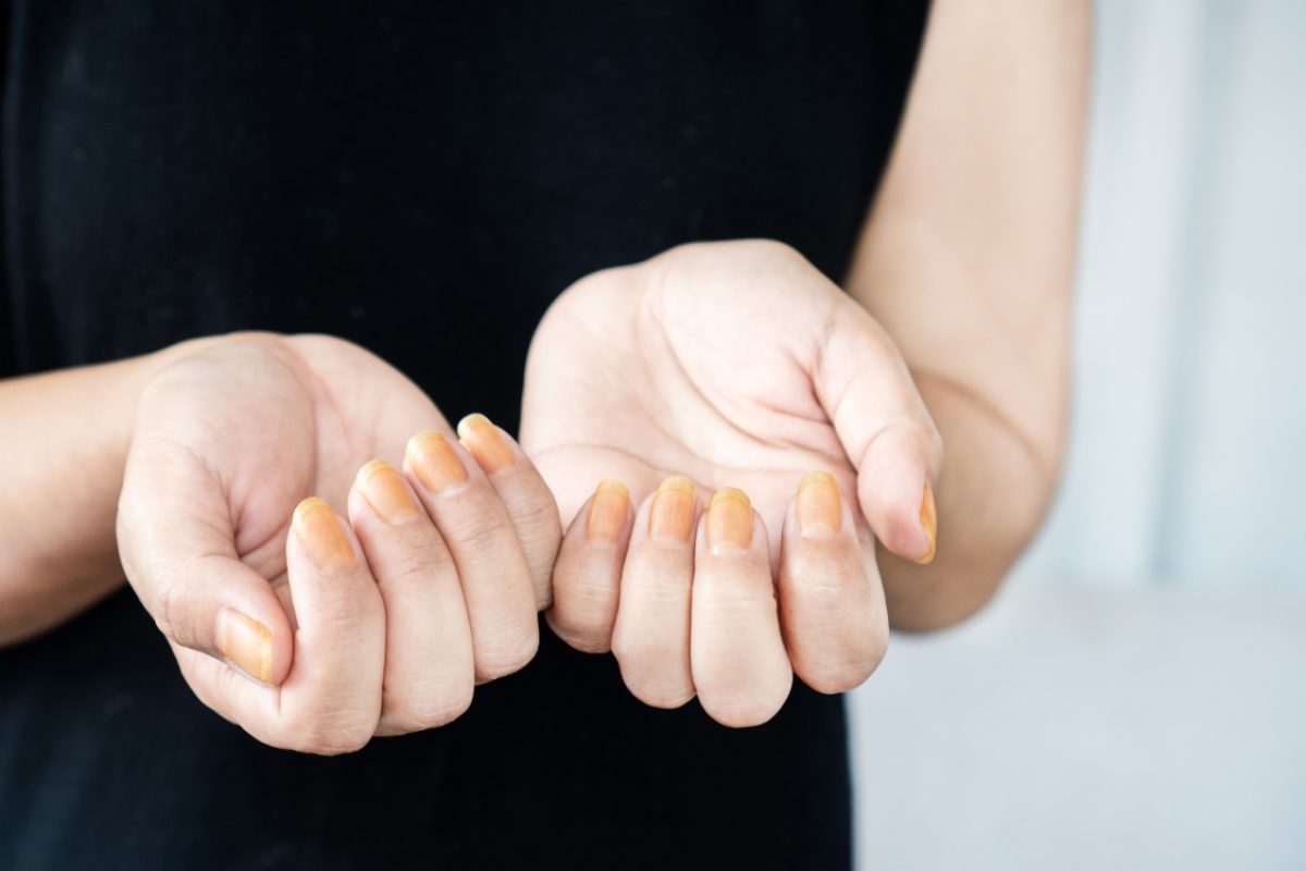 Unhas amareladas