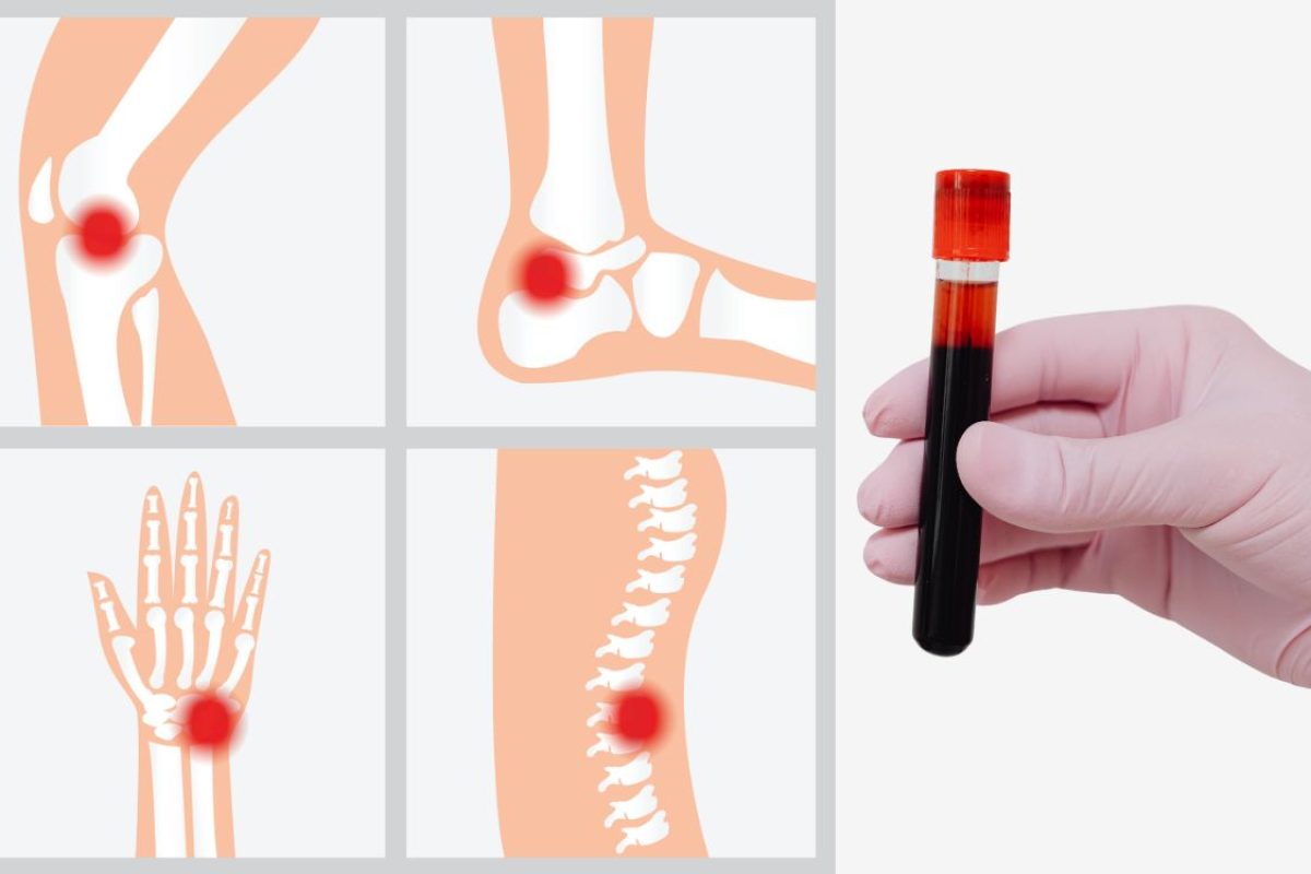 fosfatase alcalina alta.