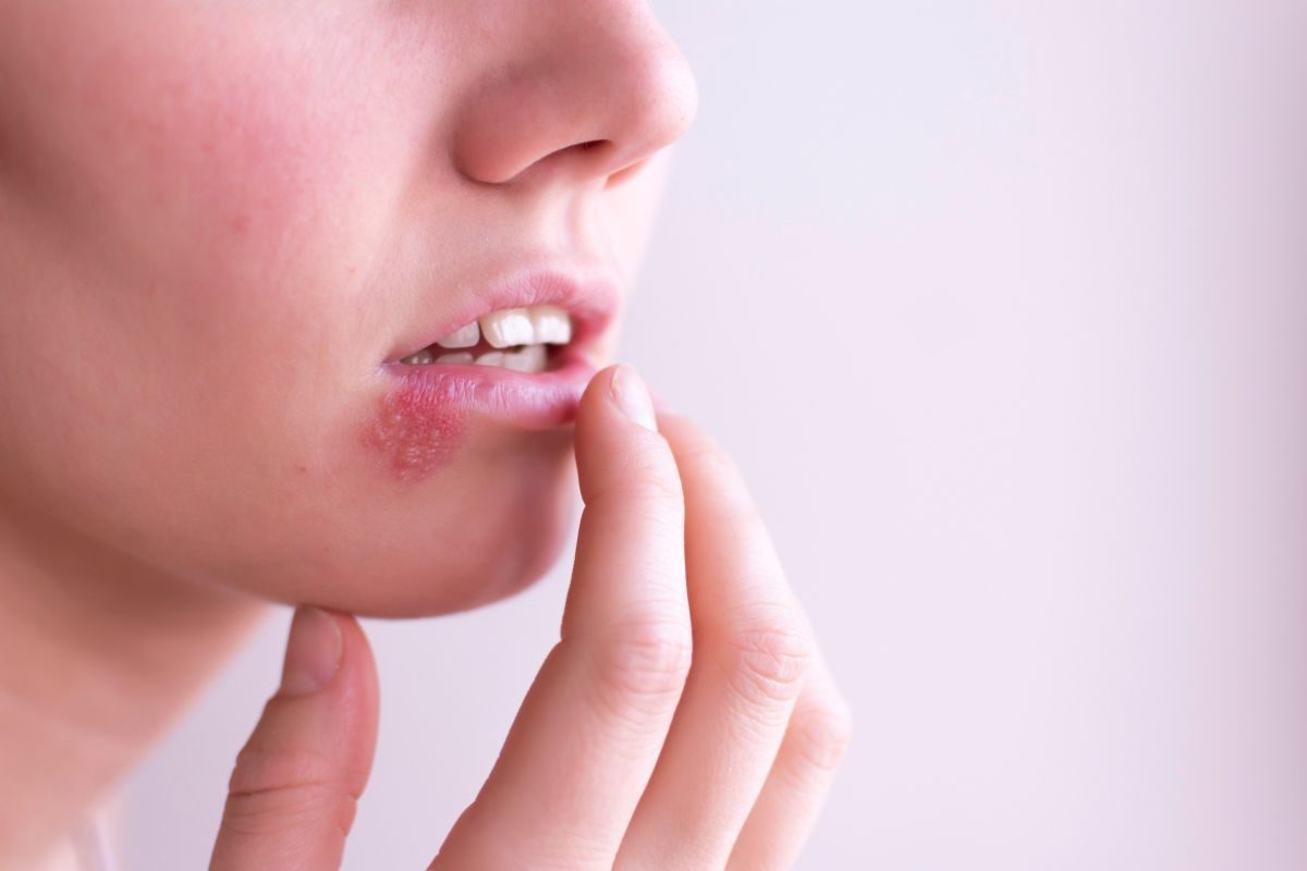 o que a herpes pode causar no organismo.