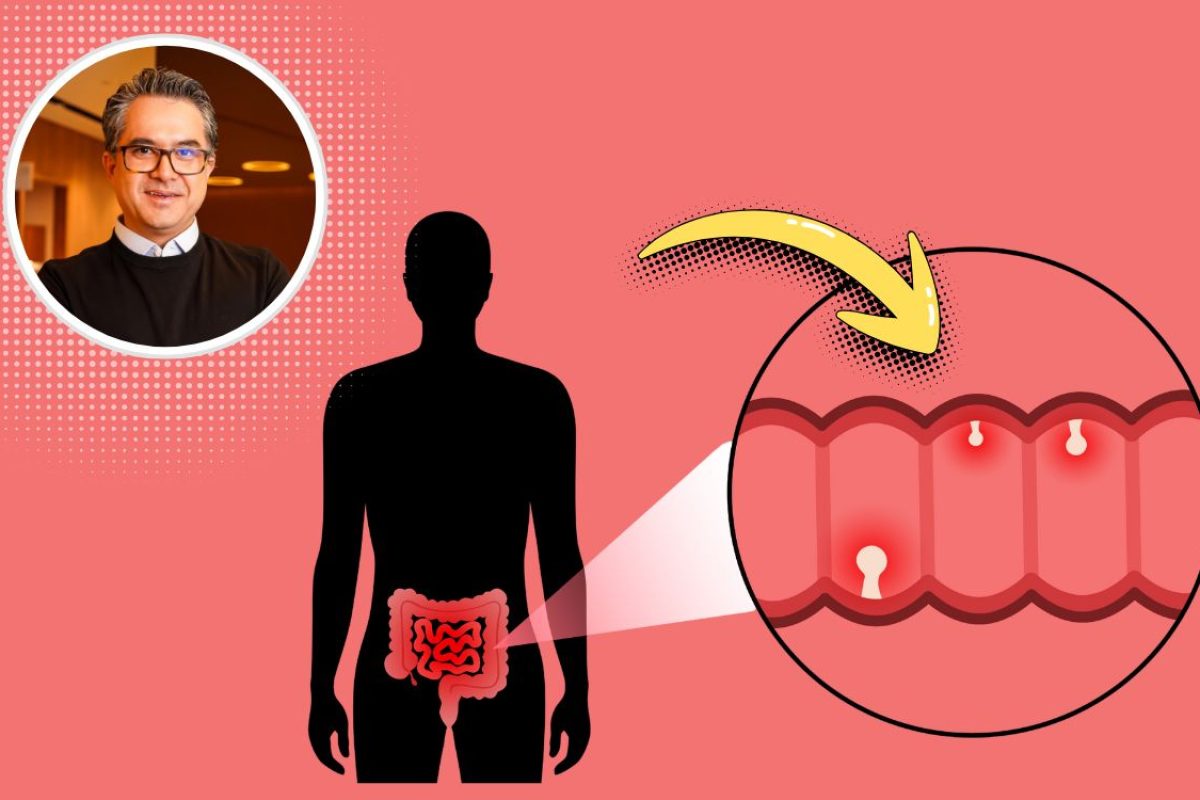 o que são pólipos intestinais.