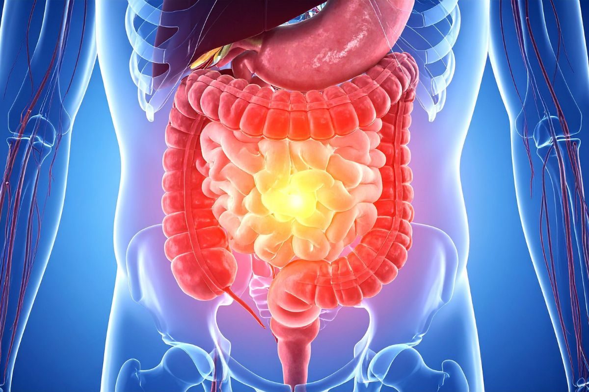 Sintomas de inflamação intestinal.