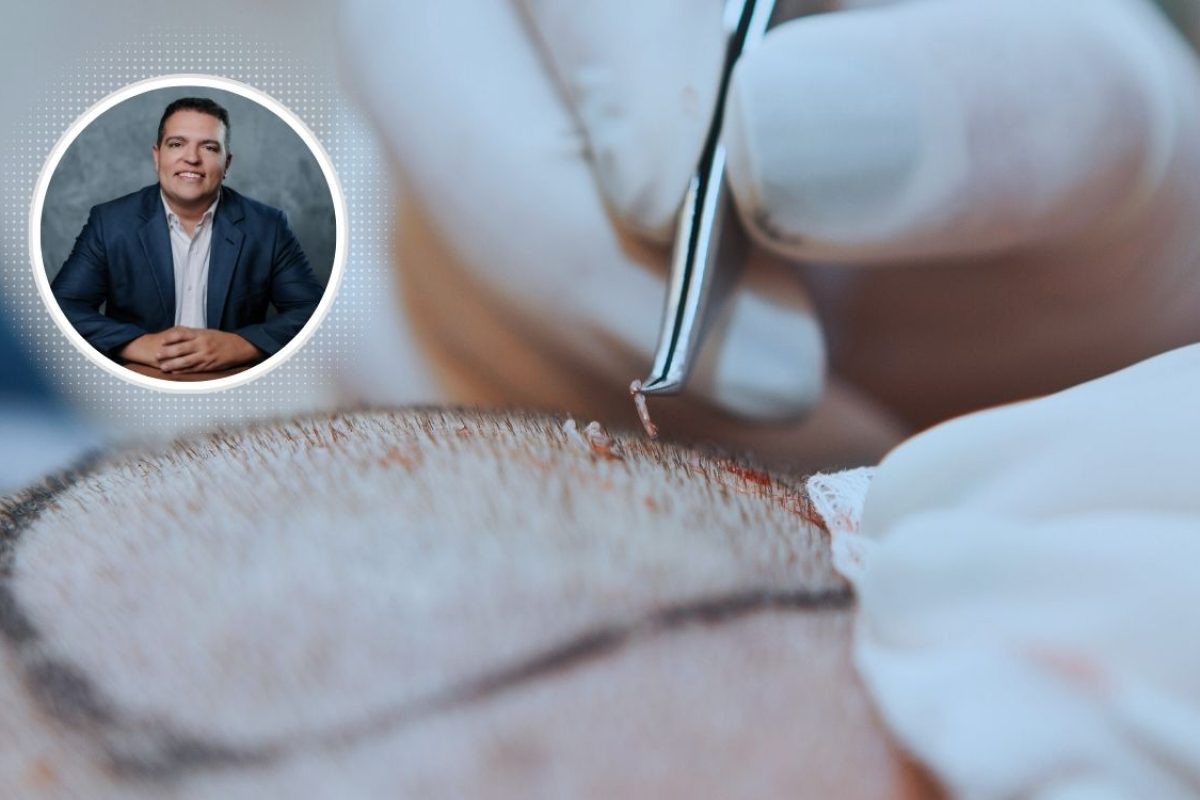 transplante capilar.